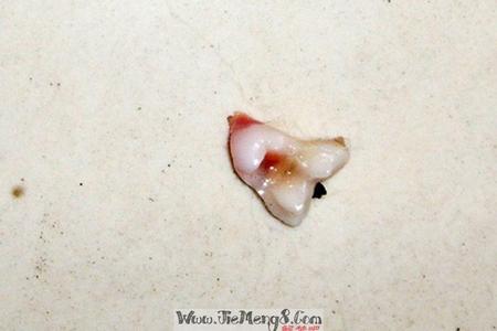 梦见牙齿在半夜突然掉落